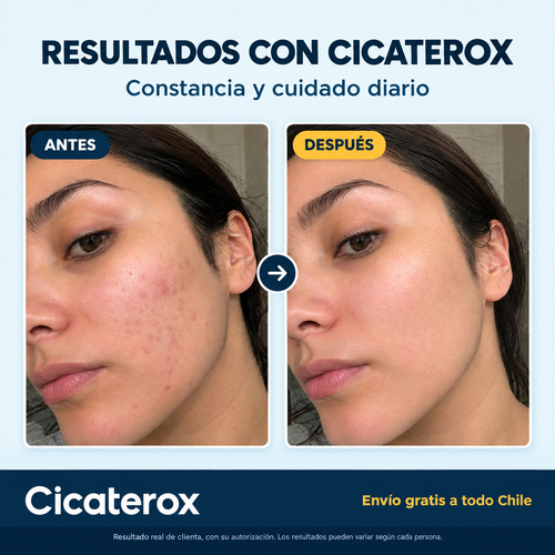 Cicaterox – Spray para Eliminar Cicatrices