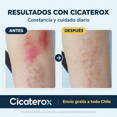 Cicaterox – Spray para Eliminar Cicatrices