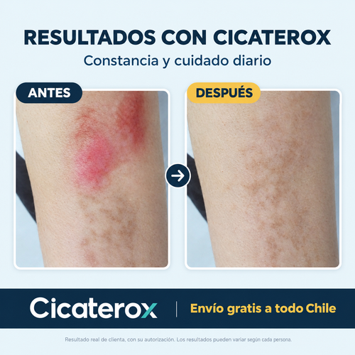 Cicaterox – Spray para Eliminar Cicatrices