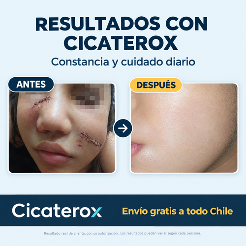Cicaterox – Spray para Eliminar Cicatrices